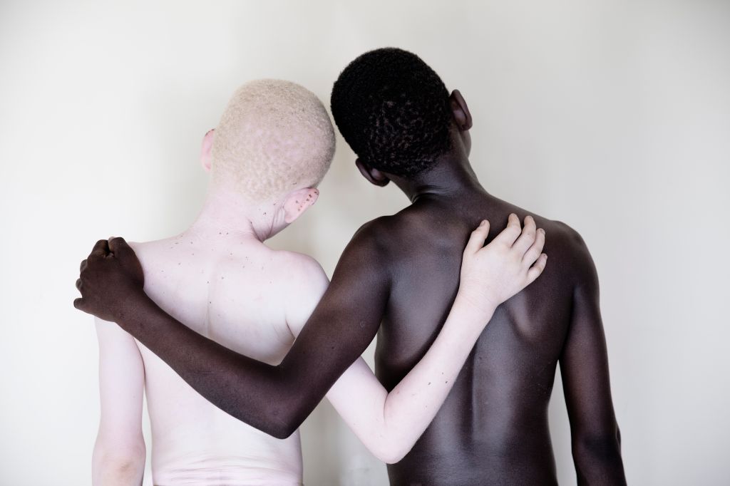 Striking Portraits Of Children With Albinism Raise Awareness Of Their Plight In Tanzania